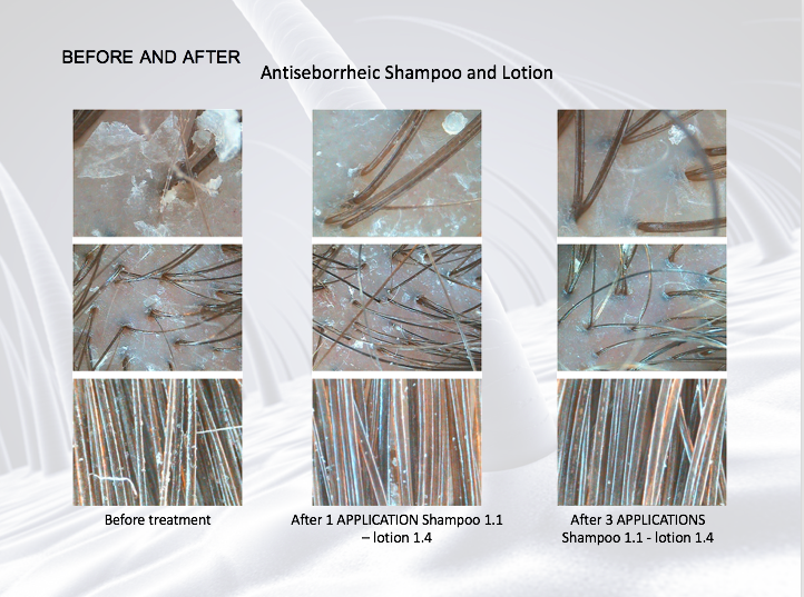 Šampón na seboreu DSD DE LUXE 1.1L. Protizápalový, proti svrbeniu a lupinám.<br>1.1L Antiseborrheic Shampoo 500ml.