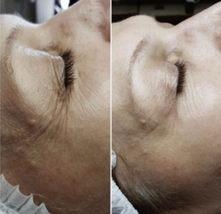 VITARAN HP CELL I, POLYNUCLEOTIDE SODIUM FROM SALMON PN - 20mg/mL 
SKIN - Inovatívny biostimulátor s polynukleotidmi z lososa, ktorý pôsobí na bunkovej úrovni. Certifikát čistoty a potvrdenej kvality. Patentovaná kórejská technológia.