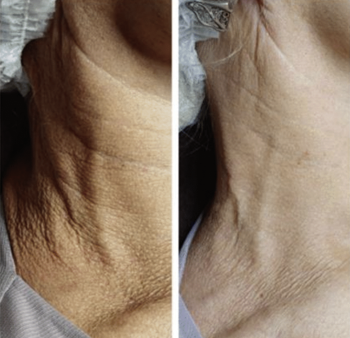 VITARAN HP CELL I, POLYNUCLEOTIDE SODIUM FROM SALMON PN - 20mg/mL 
SKIN - Inovatívny biostimulátor s polynukleotidmi z lososa, ktorý pôsobí na bunkovej úrovni. Certifikát čistoty a potvrdenej kvality. Patentovaná kórejská technológia.