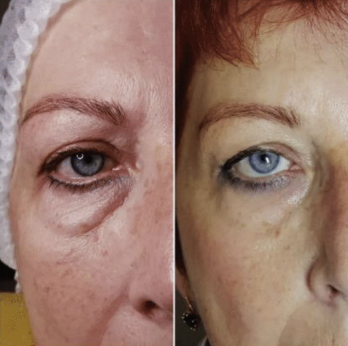 VITARAN HP CELL 4i (PN 4 ml.) + VITARAN HP SKIN BOOSTER (PNDR 8 ml.) 
SKIN & SCAR Inovatívny stimulátor tkaniva s polynukleotidmi z lososa 20mg/ml (PN) + Skin Booster z lososa a kyselinou hyalúronovou pre omladenie, obnovu a hydratáciu starnucej ple