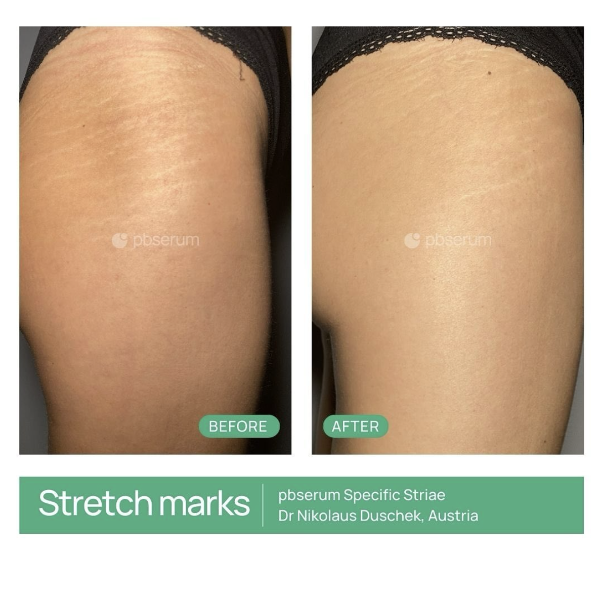 PBSERUM SPECIFIC STRIAE HOME CARE 
Ošetrenie na zjemnenie strií, na domáce použitie