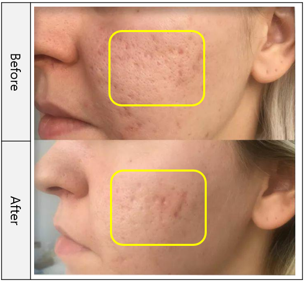 VITARAN HP CELL S, POLYNUCLEOTIDE SODIUM FROM SALMON PN - 20mg/mL 
SCAR & SKIN - Inovatívny biostimulátor s polynukleotidmi z lososa, ktorý pôsobí na bunkovej úrovni. Certifikát čistoty a potvrdenej kvality. Patentovaná kórejská technológia.