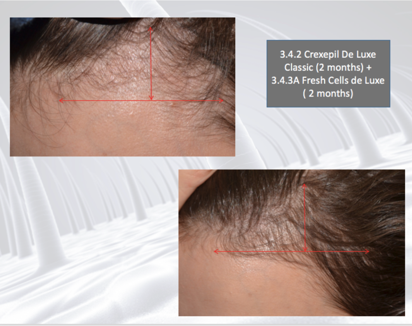 DSD SIMONE DE LUXE WONDERCELL LOTION 
3.4.3A  Vlasové hnojivo na rast vlasov. Hydratácia a stimulácia rastu vlasov.