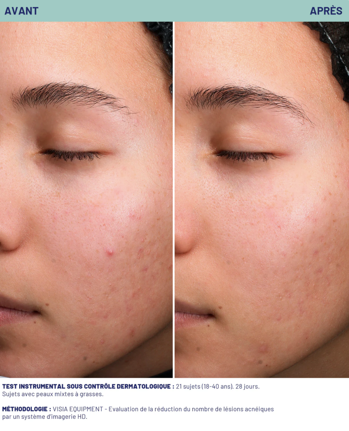 SOSKIN AKN STOP IMPERFECTION SERUM 
Na zapálené akne lokality 15 ml.